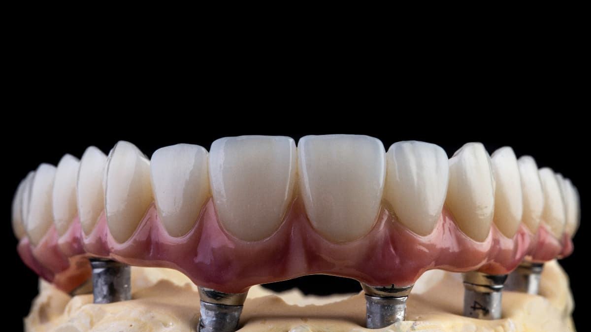 Crowns and Bridges FAQs Prime Dental