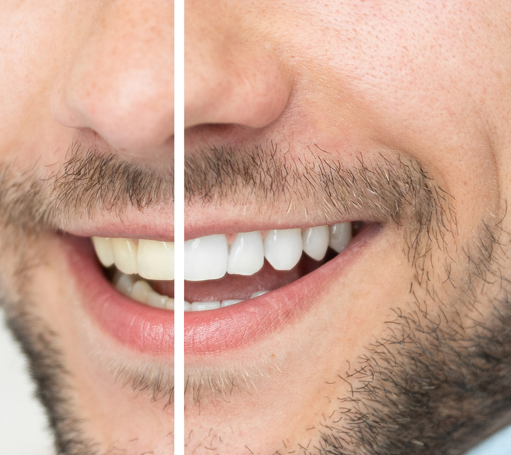 teeth whitening before and after at Milwaukie cosmetic dentist